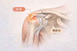 肩関節の炎症